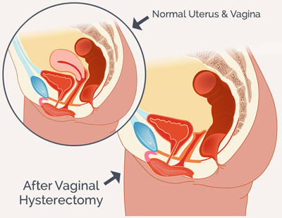 Hysterectomy (Abdominal / Vaginal)