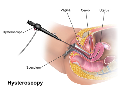 Hysteroscopic Surgery